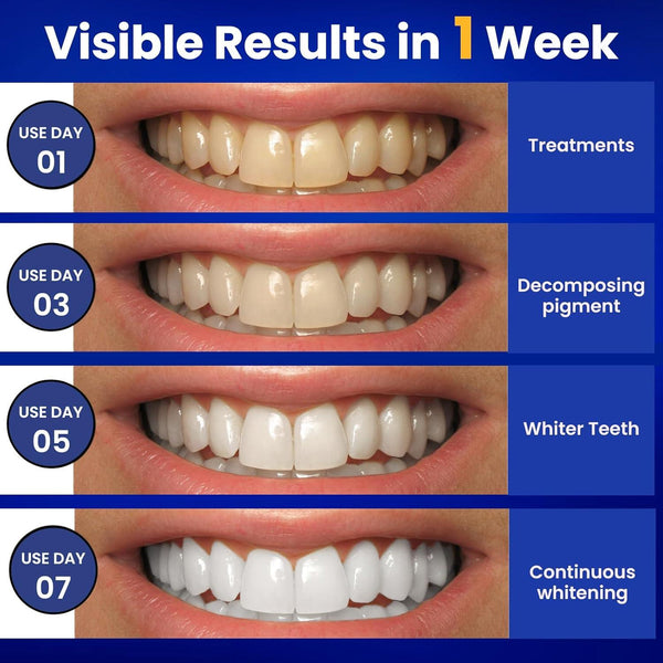 Brilliant Smile Whitening Strips